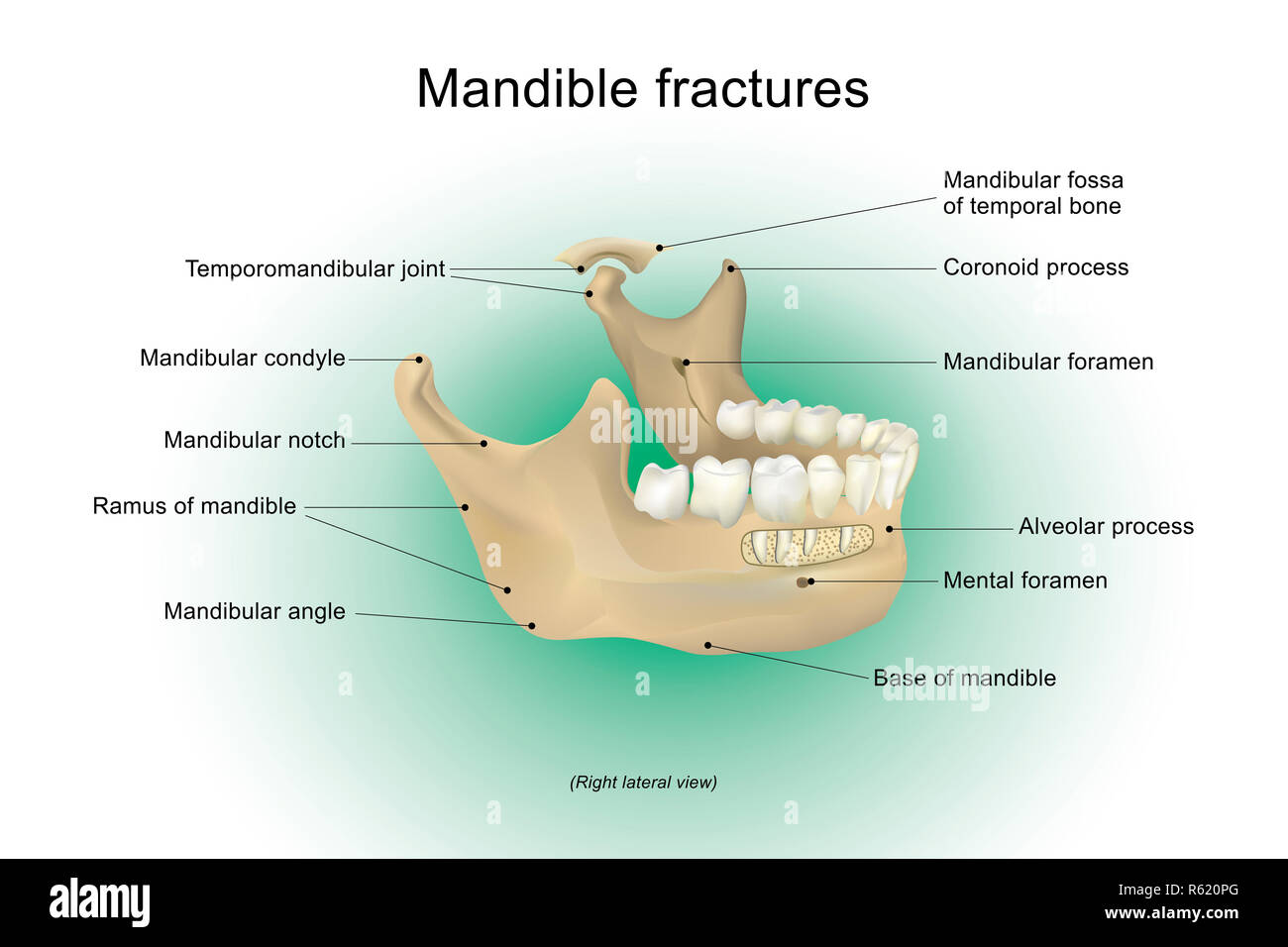 Anatomie d'une mandibule fractures. Banque D'Images