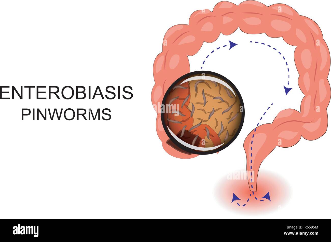 Illustration de l'intestin souffrant de entérobiase Illustration de Vecteur