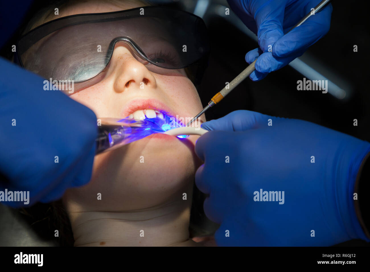 Fissures de durcissement UV avec de la lumière ultraviolette sur les dents en arrière qui ont souffert de l'hypominéralisation / fluorose de l'émail des dents. UK. (104) Banque D'Images