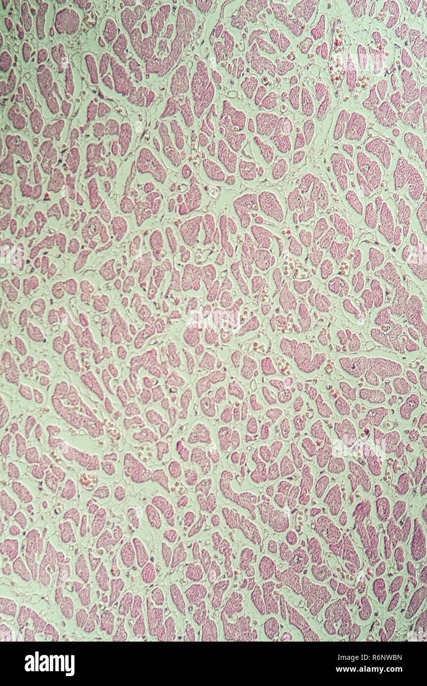 Crise cardiaque sous le microscope Banque D'Images