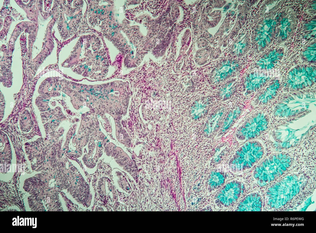 L'adénocarcinome Banque D'Images