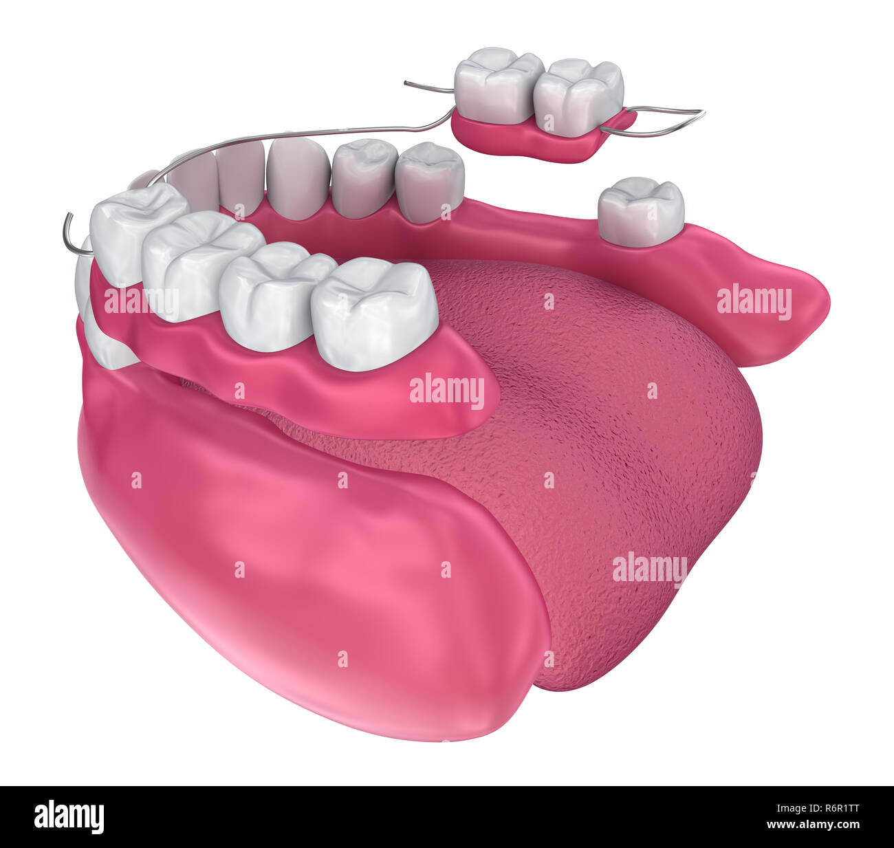 La prothèse partielle amovible. Illustration 3D précis médicalement Banque D'Images