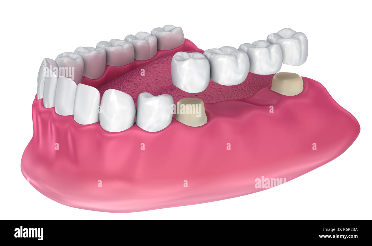 Pont fixe pris en charge de la dent. Illustration 3D précis médicalement Banque D'Images