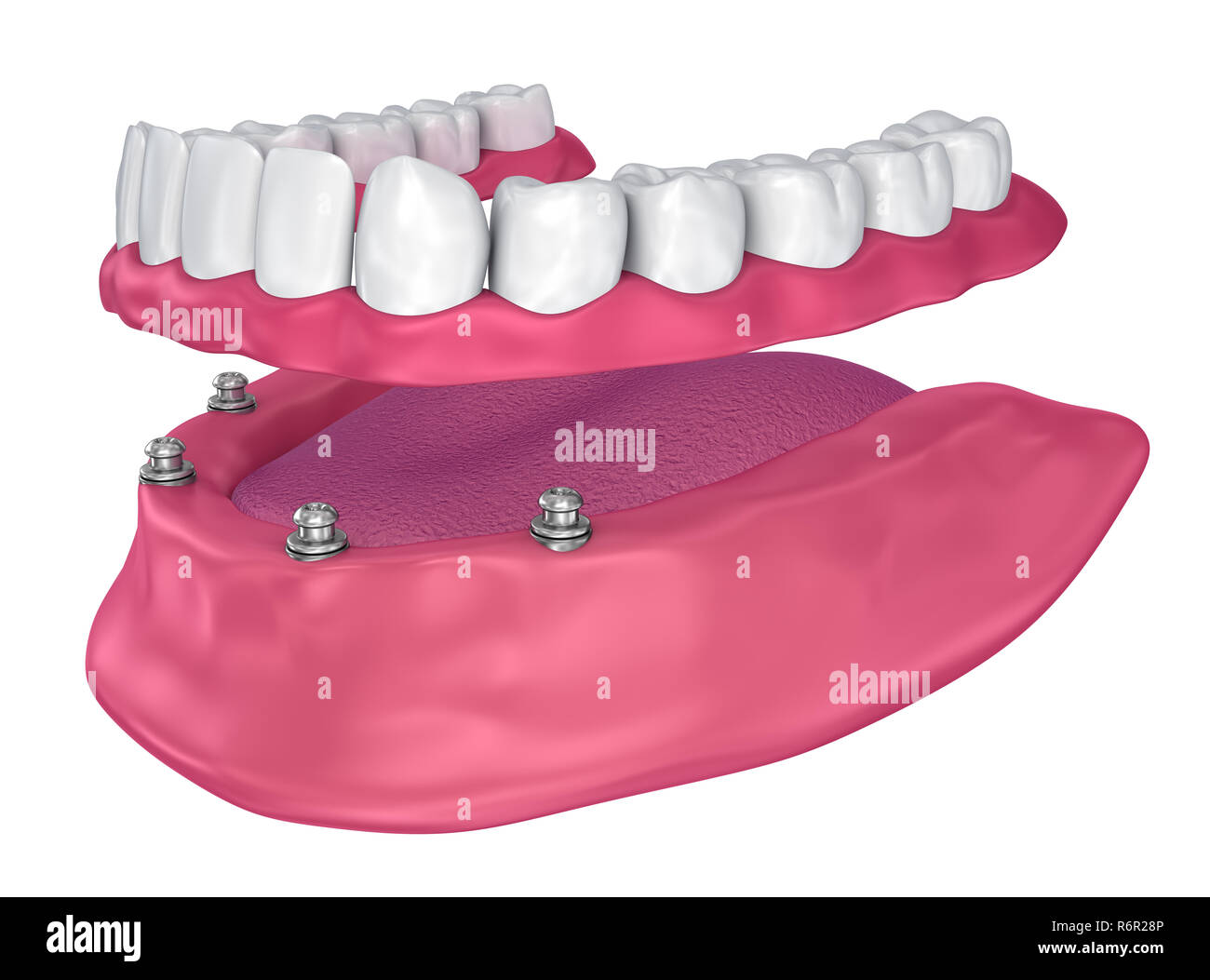 Pour Prothèse hybride être assis sur implants - ball pièces jointes. 3D illustration Banque D'Images