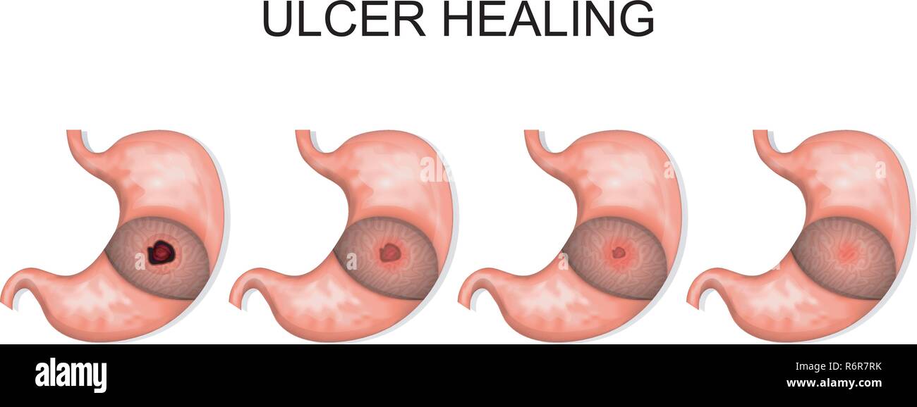 Une illustration du processus de guérison de l'ulcère Illustration de Vecteur