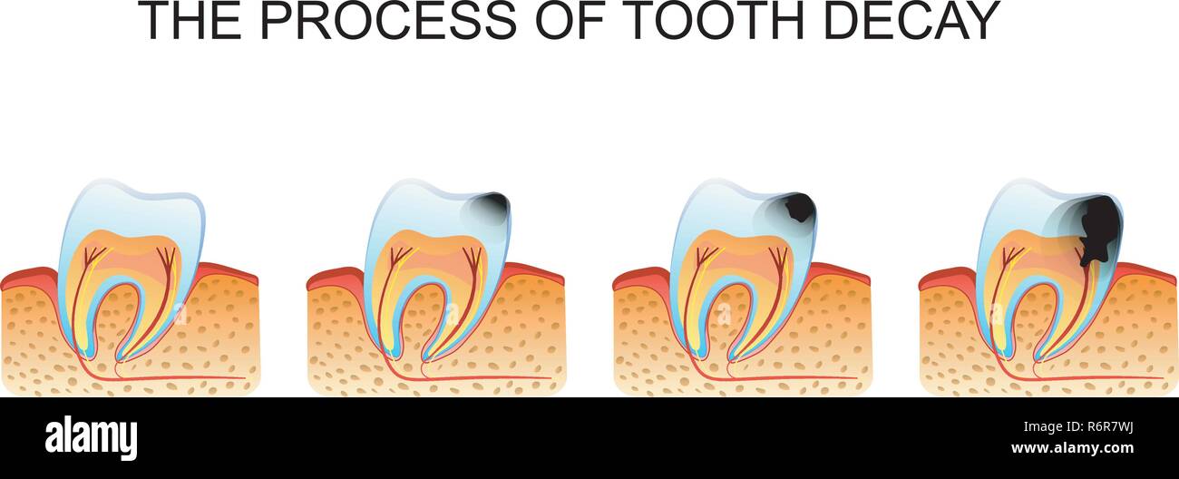 Illustration de la carie dentaire la carie dentaire Illustration de Vecteur