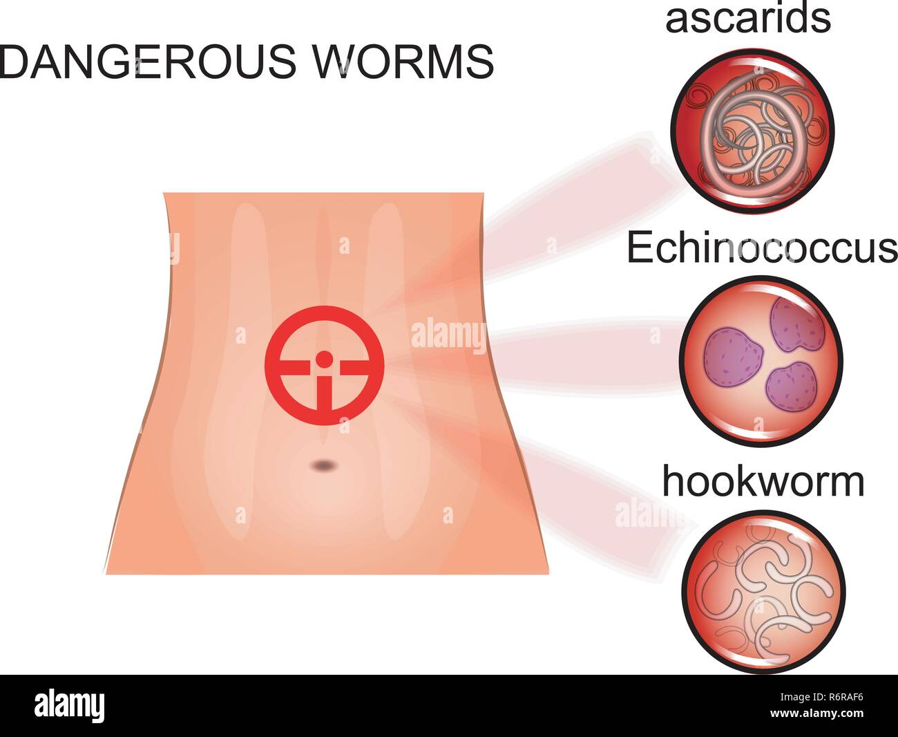 Vector illustration d'helminthoses intestinales chez l'homme. pour les publications dans des brochures médicales Illustration de Vecteur