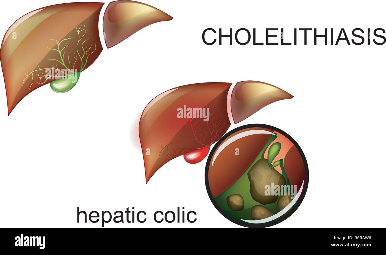 Vector illustration de cholélithiase. Des pierres dans la vésicule biliaire. Illustration de Vecteur