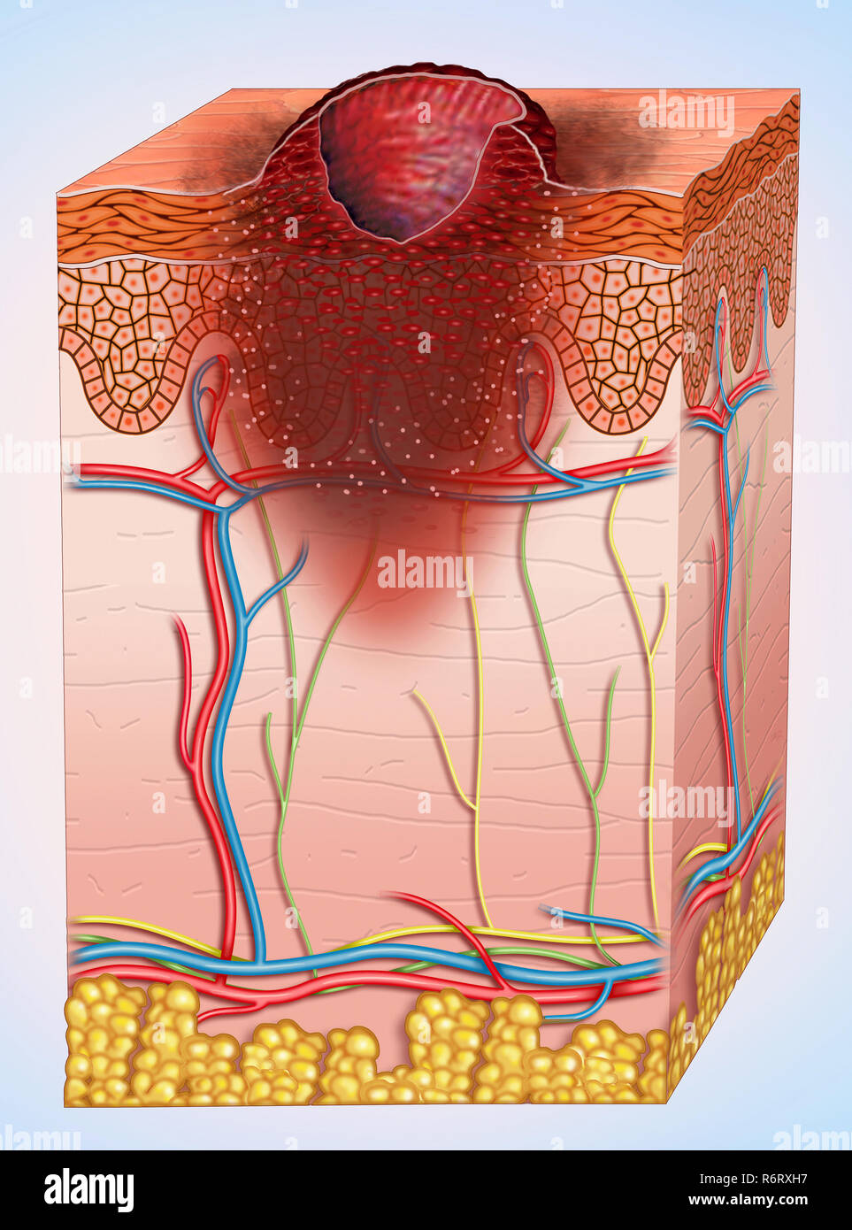 C'est le stade du cancer de la peau de mélanome. L'ulcération est une rupture dans la peau au-dessus du mélanome. Les mélanomes ulcérés ont tendance à avoir un pronostic plus mauvais. Banque D'Images