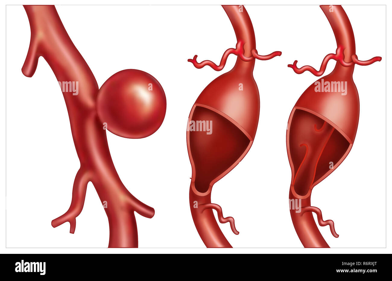 Illustration schématique des types d'anévrismes, c'est l'élargissement d'une artère. Les types d'anévrismes du cerveau sont : sacculaire, fusiforme et secte. Banque D'Images