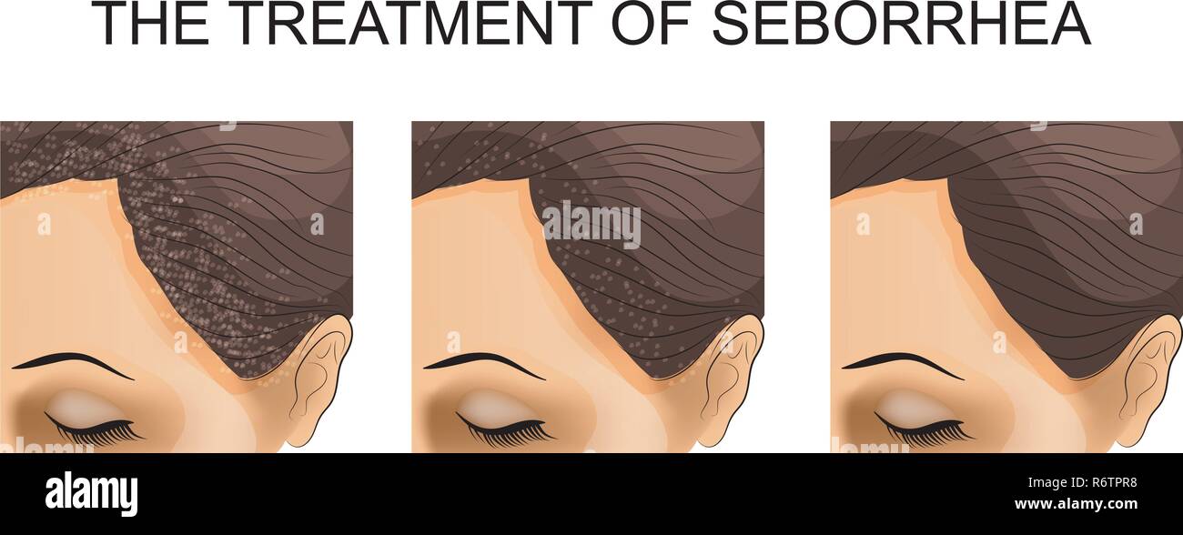 Illustration du traitement de la séborrhée avant et après. Illustration de Vecteur Illustration du traitement de la séborrhée avant et après. Illustration de Vecteur