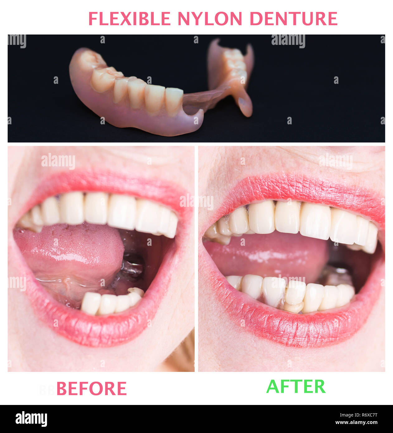 Avec la réhabilitation dentaire dentier inférieur en nylon souple, avant et après le traitement. Dentiers amovibles souples, dépourvue de nylon, exempt de monomère hypoallergénique Banque D'Images