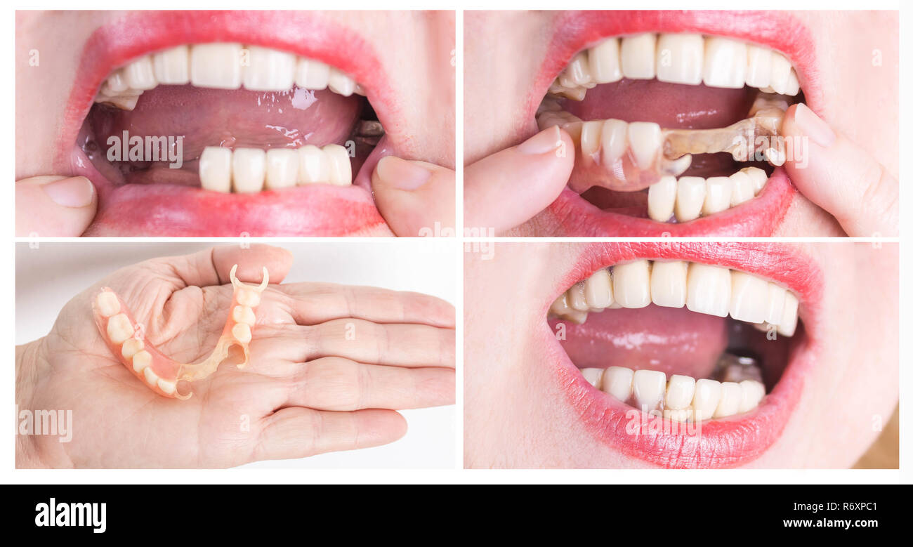 Avec la réhabilitation dentaire prothèse supérieure et inférieure, avant et  après le traitement Photo Stock - Alamy