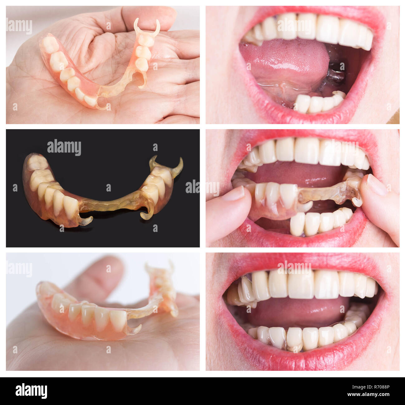 Avec la réhabilitation dentaire dentier inférieur en nylon souple, avant et après le traitement. Dentiers amovibles souples, dépourvue de nylon, exempt de monomère hypoallergénique Banque D'Images