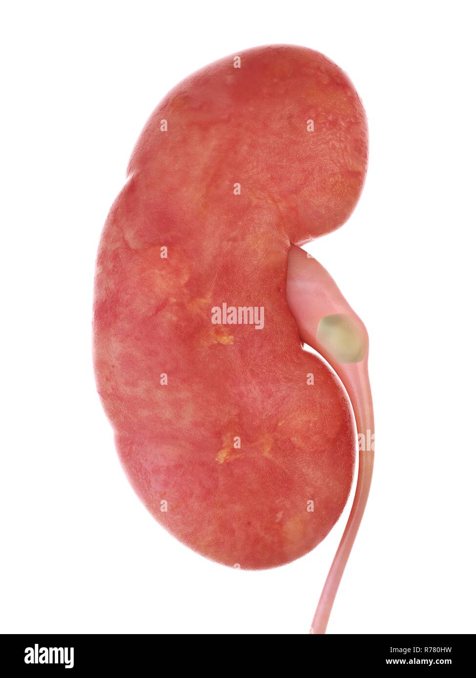 Rendu 3d illustration d'un calcul rénal. Banque D'Images