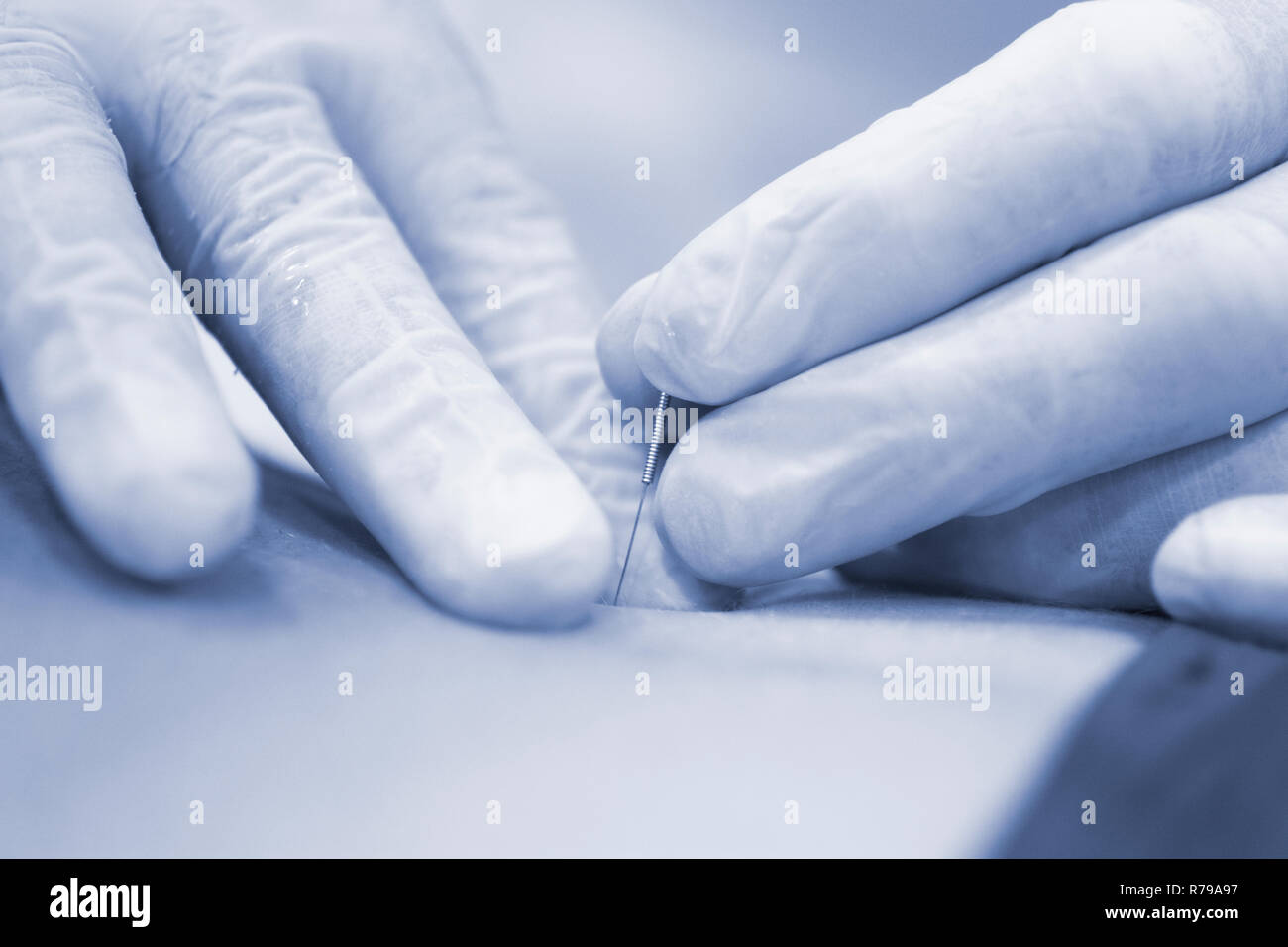 Intratissue clinique de physiothérapie du PEV L'Électrolyse percutanée aiguille sèche physiothérapeute de blesser le patient. Banque D'Images