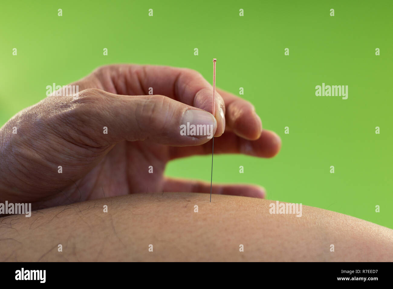 Aiguille sèche, l'acupuncture. Une journée dans la vie d'un kinésithérapeute, acupuncteur. Banque D'Images