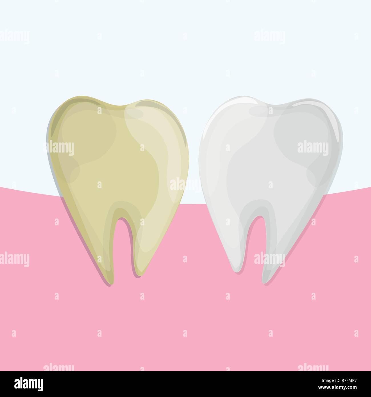 Blanchiment des dents professionnel, en bonne santé et des dents jaunes, vector illustration Illustration de Vecteur