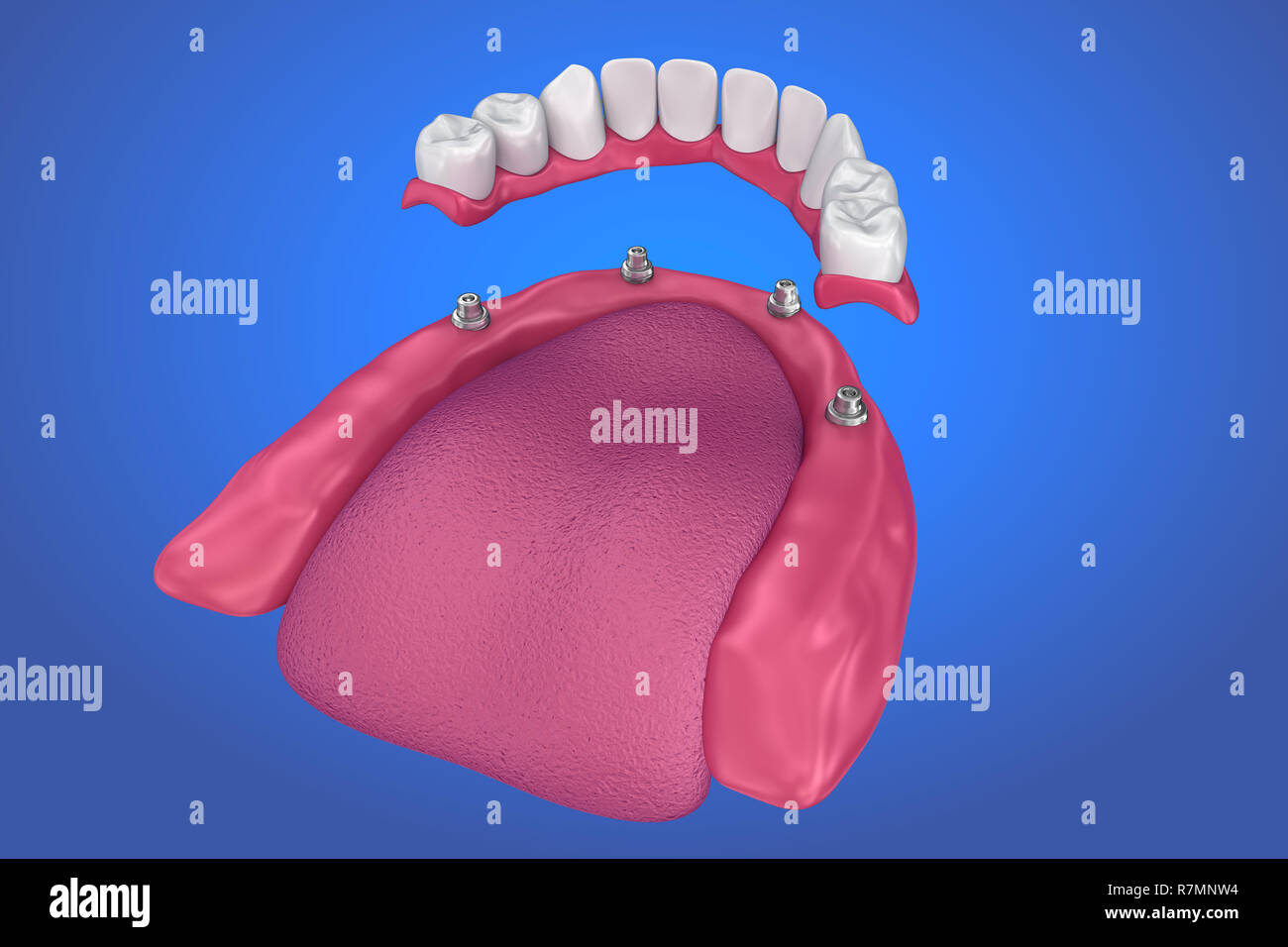 Pont fixe sur implants. Illustration 3D précis médicalement Banque D'Images Pont fixe sur implants. Illustration 3D précis médicalement Banque D'Images