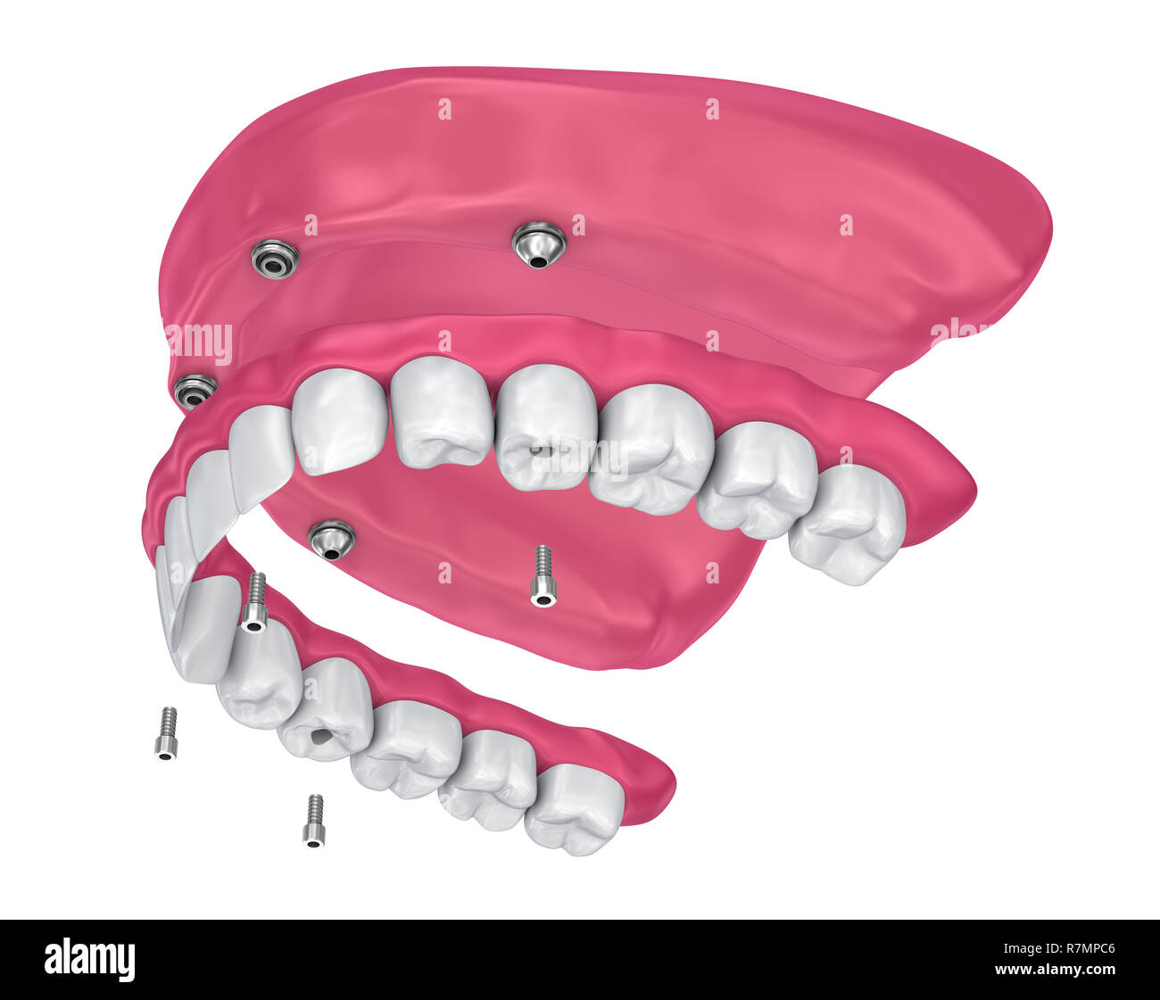 Pour Prothèse hybride être assis sur implants pièces jointes. 3D illustration Banque D'Images
