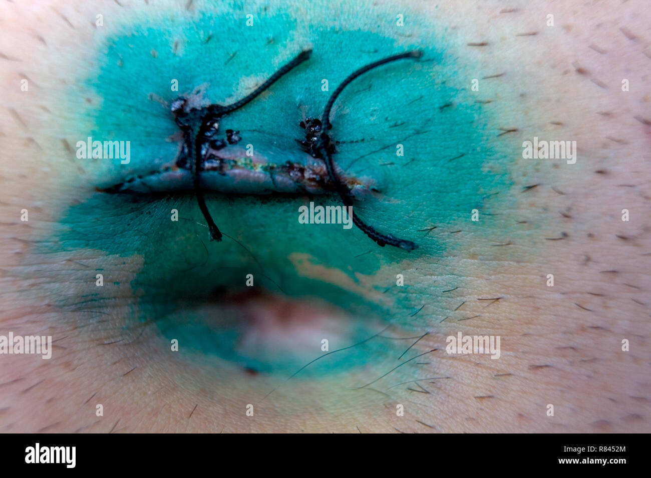 Points médicaux sur le corps après laparoscopie. Close-up. Banque D'Images
