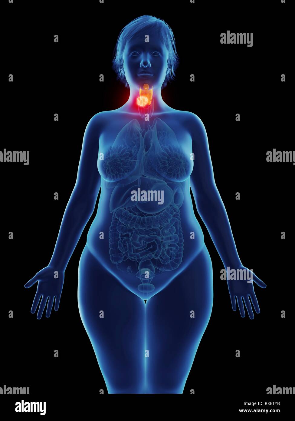 Illustration d'une tumeur dans le larynx. Banque D'Images