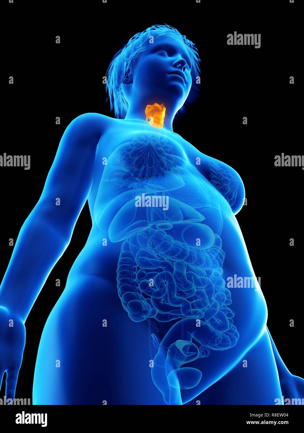 Illustration d'une femme obèse du larynx. Banque D'Images