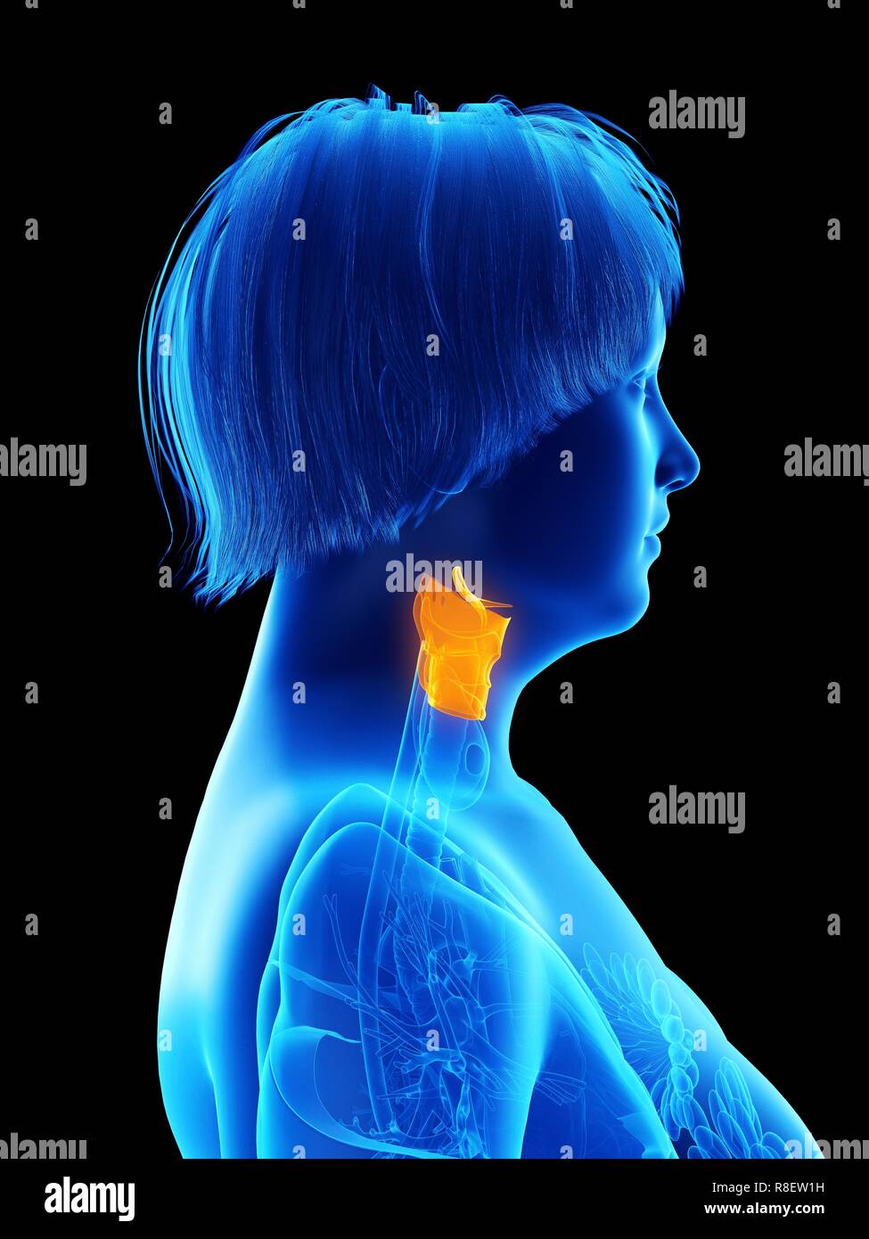 Illustration d'une femme obèse du larynx. Banque D'Images