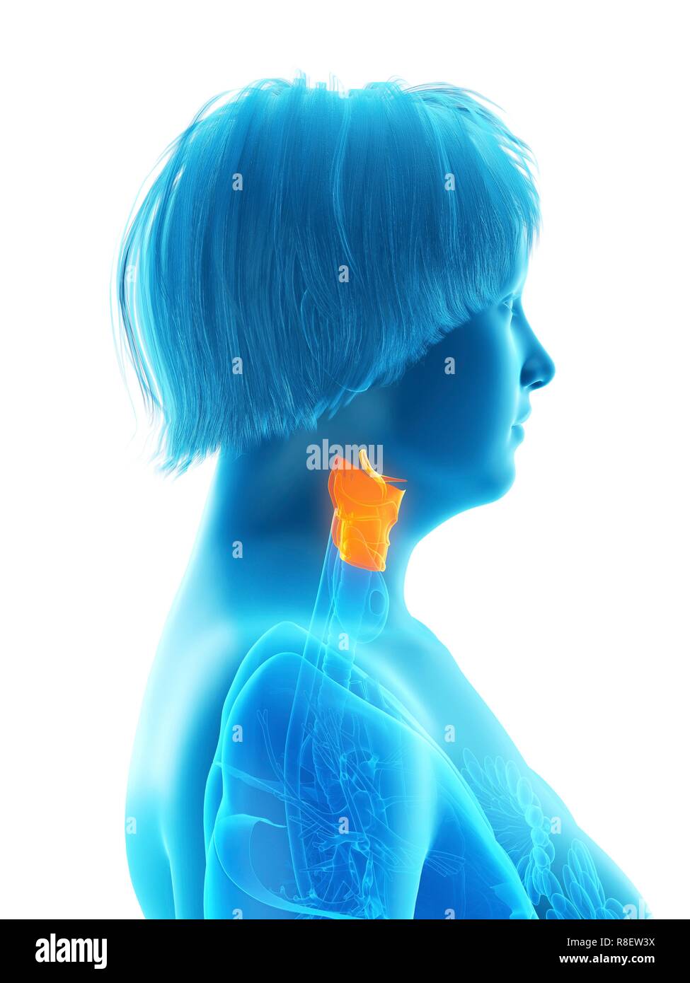 Illustration d'une femme obèse du larynx. Banque D'Images