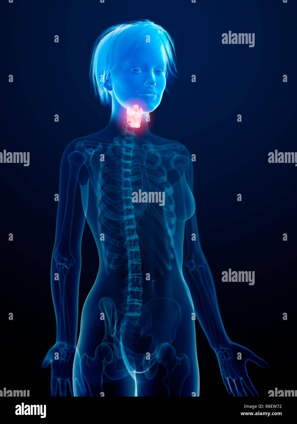 Illustration d'une inflammation du larynx. Banque D'Images