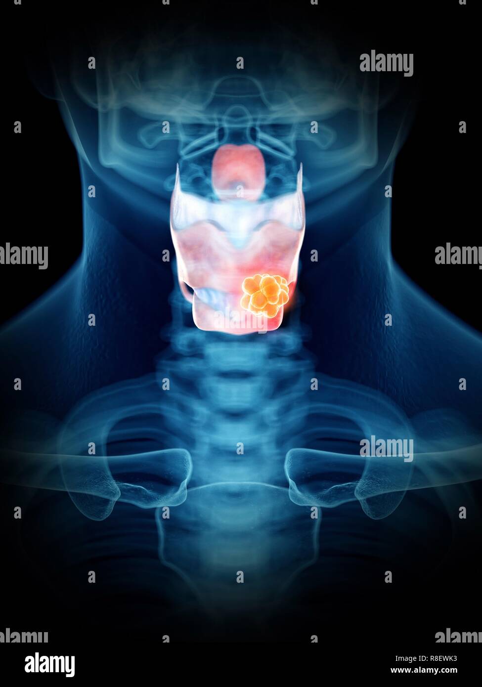Illustration d'une tumeur du larynx de l'homme. Banque D'Images