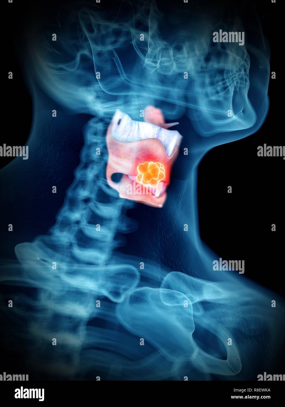 Illustration d'une tumeur du larynx de l'homme. Banque D'Images