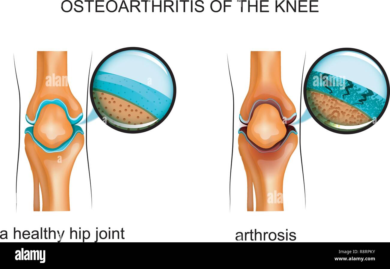 Vector illustration de l'arthrose du genou Illustration de Vecteur