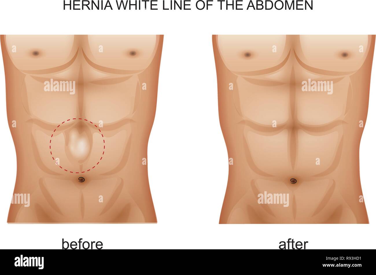 Vector illustration d'une ligne blanche hernie de l'abdomen Illustration de Vecteur Vector illustration d'une ligne blanche hernie de l'abdomen Illustration de Vecteur