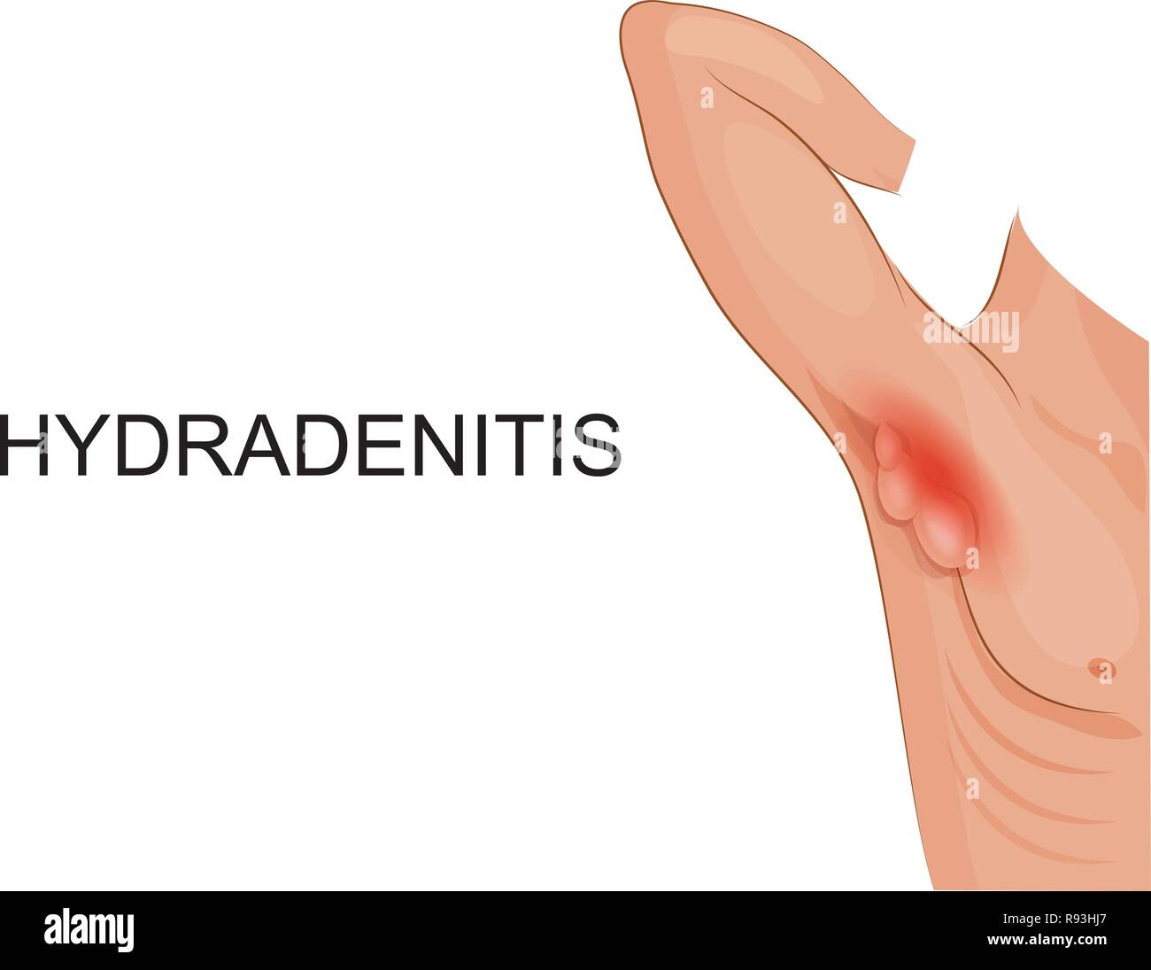 Vector illustration of hydradenitis. inflammation des glandes de sueur. Illustration de Vecteur