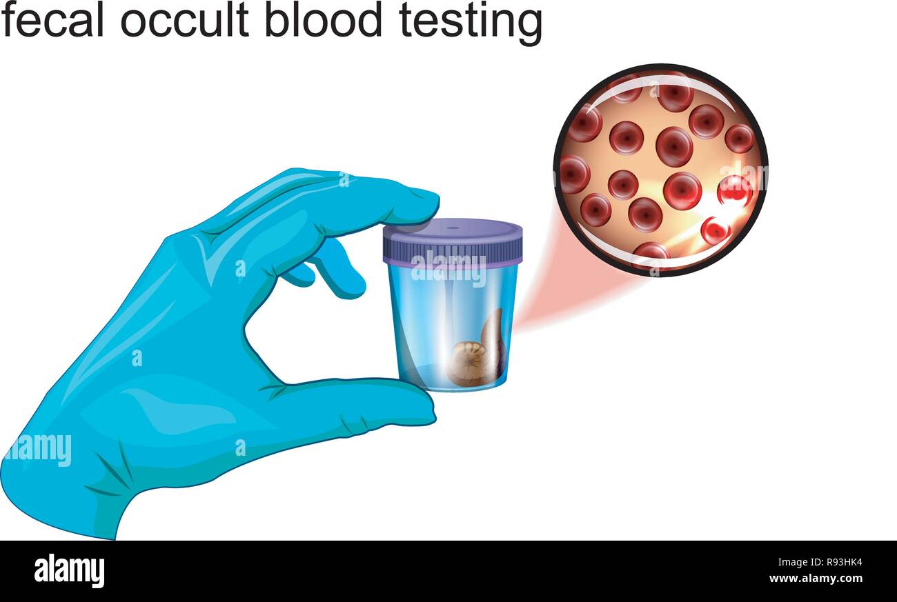 La recherche de sang occulte dans les selles. vector illustration Image  Vectorielle Stock - Alamy