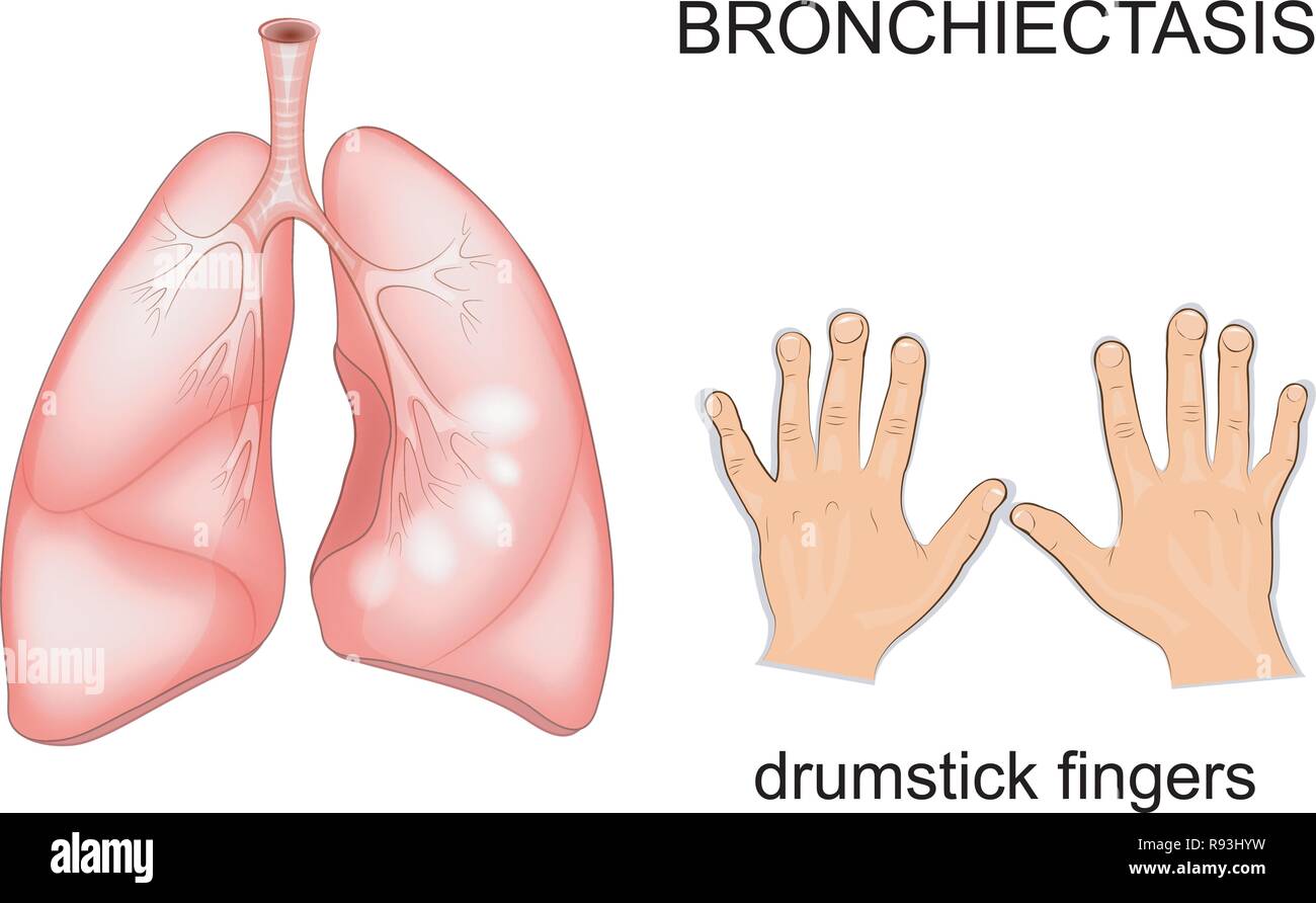 Vector illustration d'une maladie des poumons du patient la bronchiectasie.  doigts comme baguettes de tambour Image Vectorielle Stock - Alamy