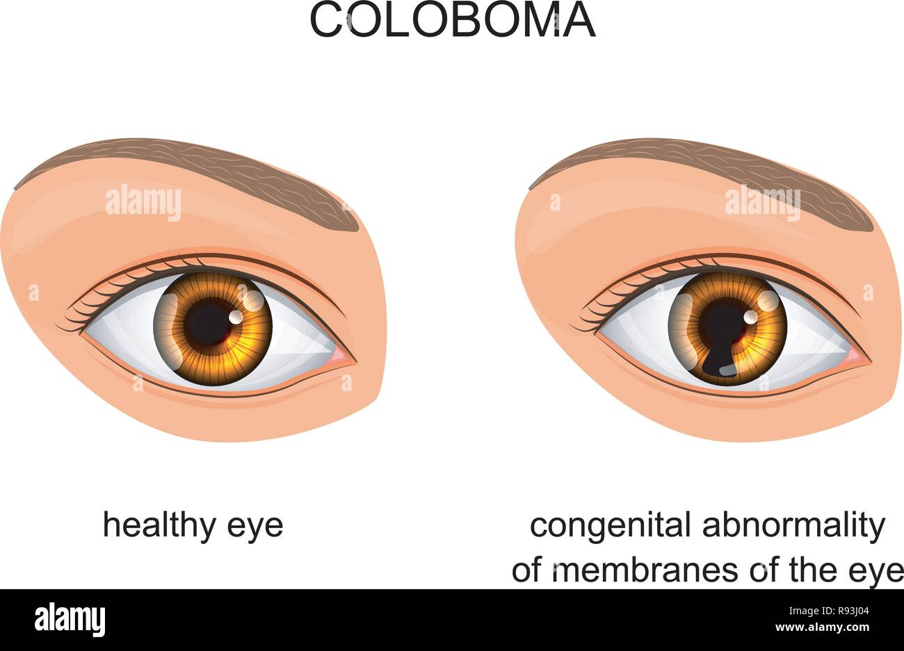 Vector illustration of congenital disorder des membranes de l'œil. Le colobome Illustration de Vecteur