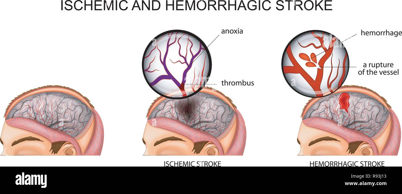 Vector illustration des vaisseaux du cerveau et une brève description des causes de l'accident vasculaire cérébral Illustration de Vecteur