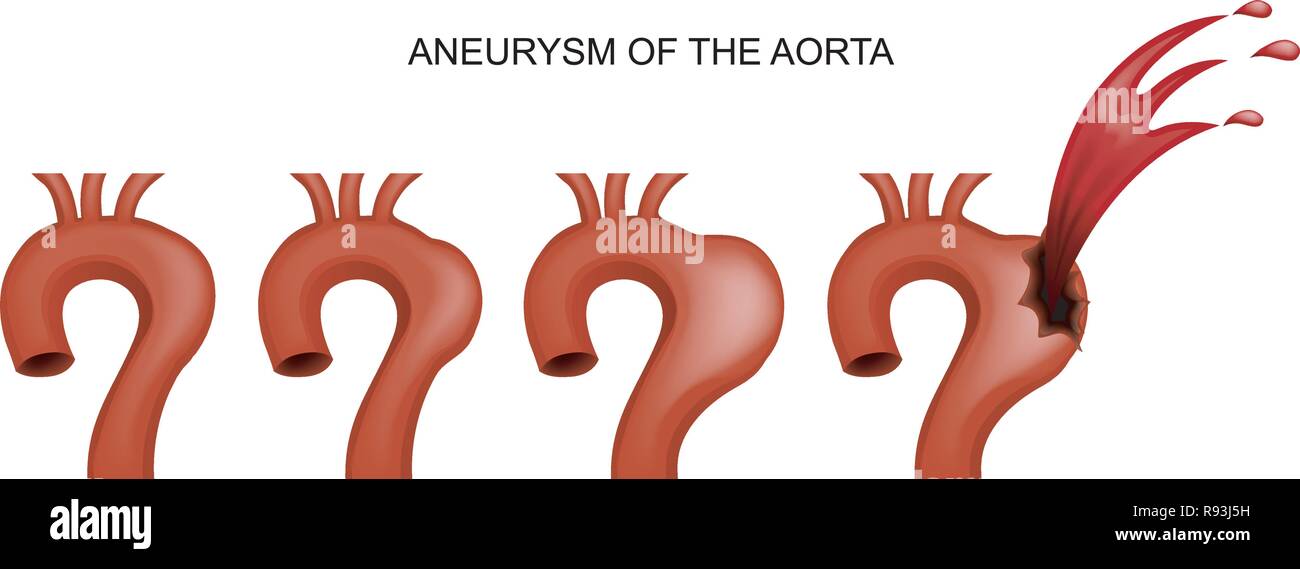 Vector illustration d'un anévrisme aortique en cardiologie. Illustration de Vecteur