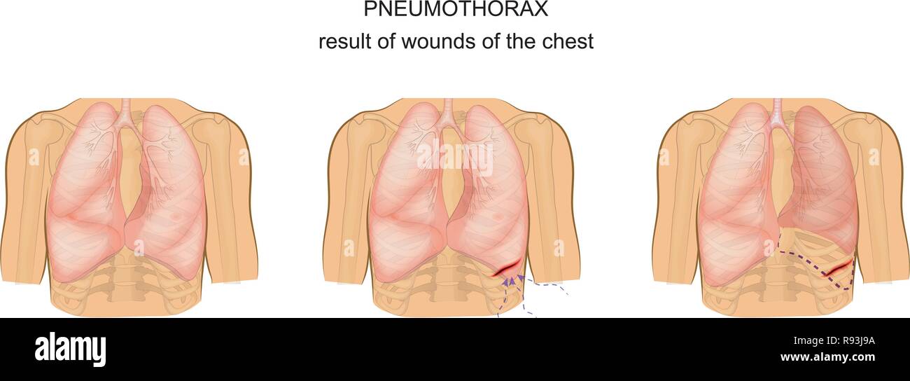 Vector illustration d'un pneumothorax par suite de blessures de la poitrine Illustration de Vecteur