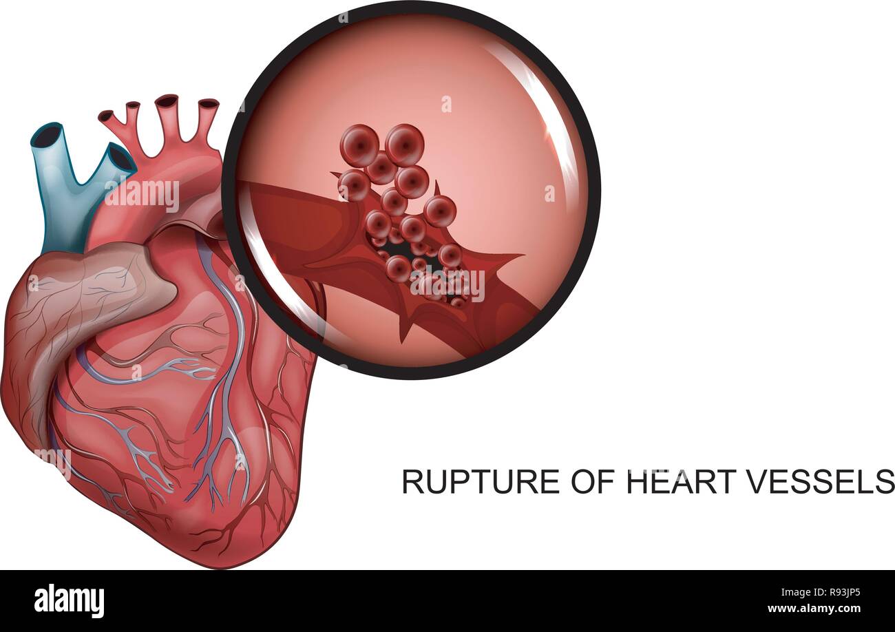 Artery rupture Banque de photographies et d’images à haute résolution