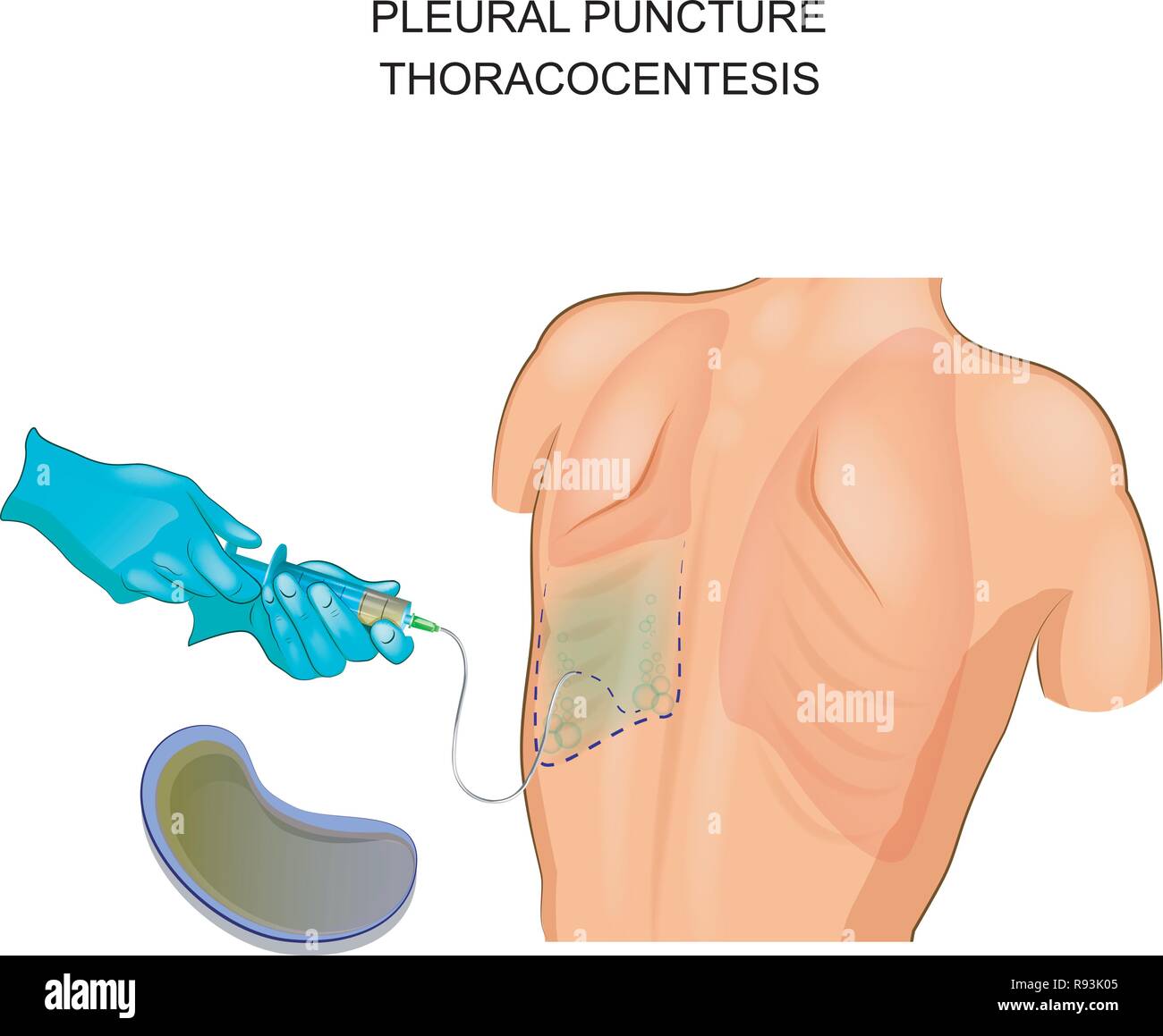 Vector illustration d'une thoracentèse, une ponction pleurale Illustration de Vecteur
