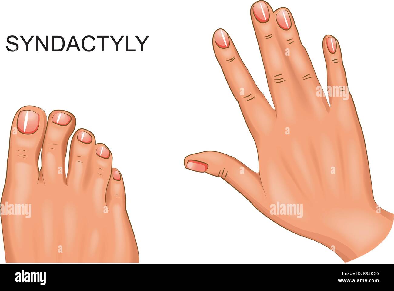 Vector illustration de syndactylie des mains et des pieds palmés Image  Vectorielle Stock - Alamy