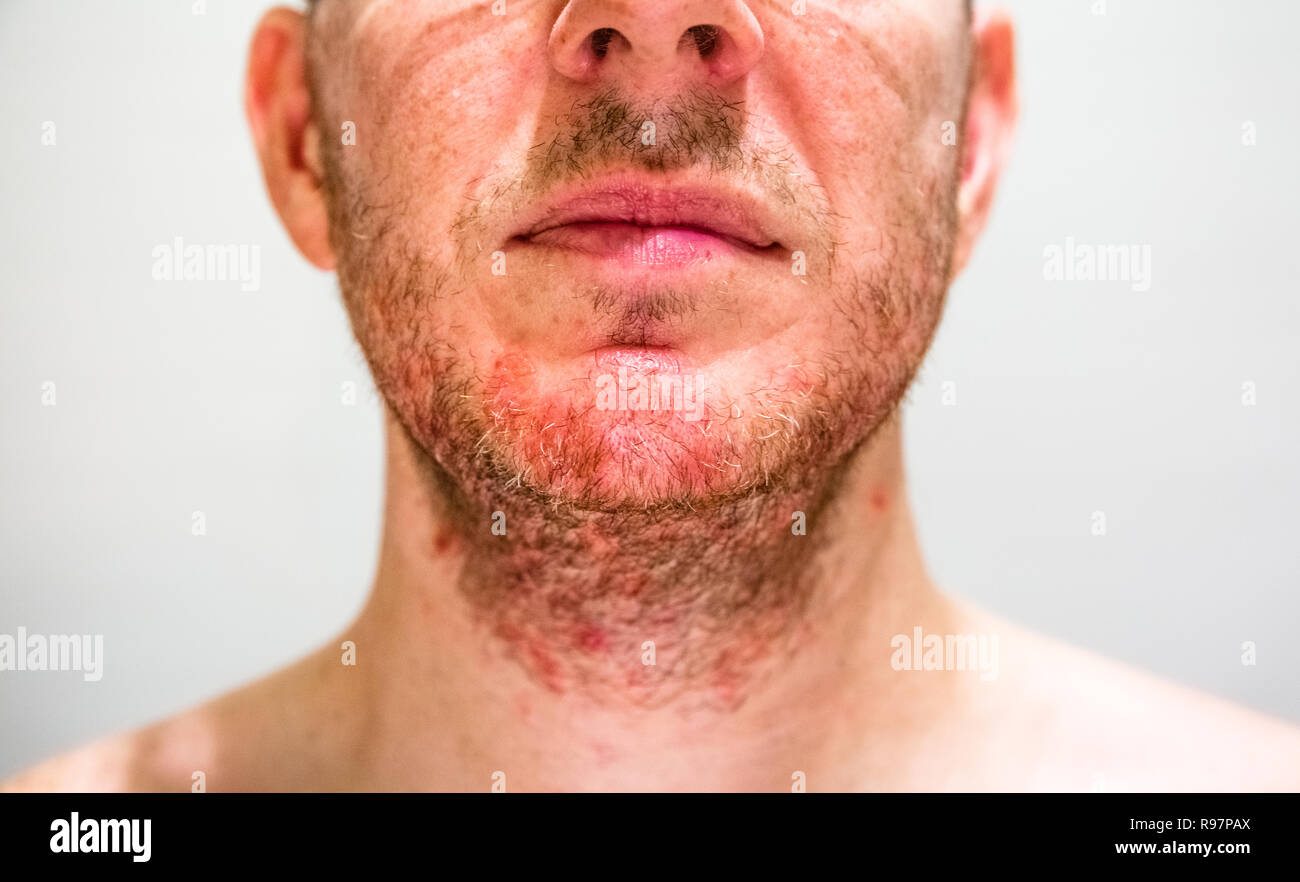 L'homme avec la dermatite séborrhéique dans la région de beard Banque D'Images