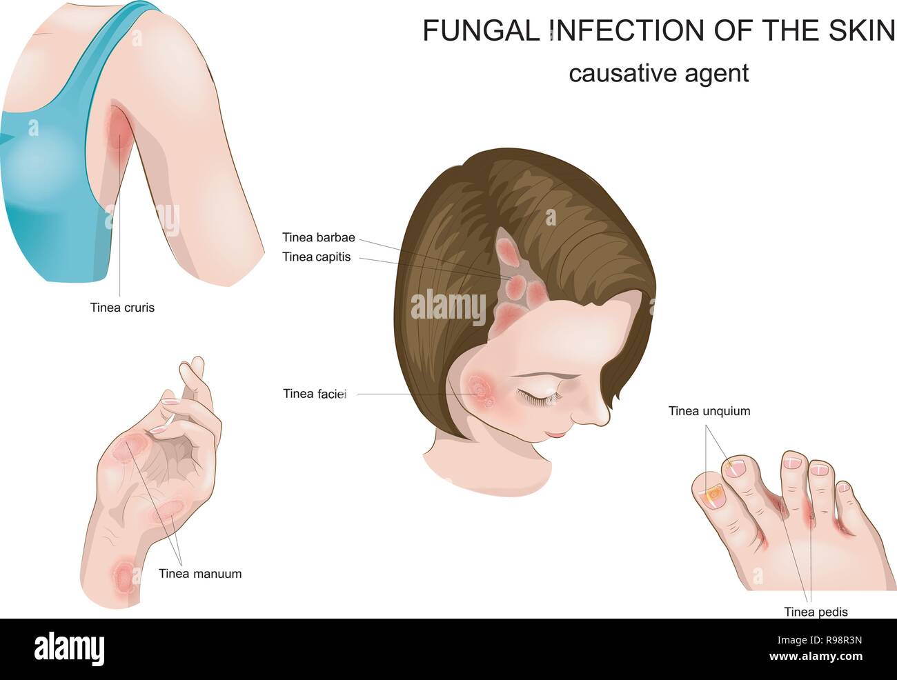 Vector illustration de la peau et les cheveux,ongles champignon Illustration de Vecteur