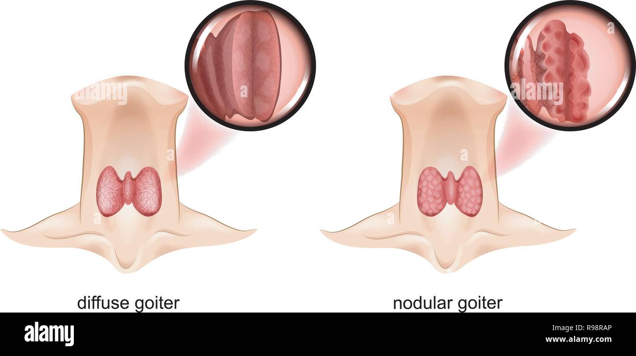 Vector illustration de goitre nodulaire et diffuses, la glande thyroïde est une vue en coupe Illustration de Vecteur