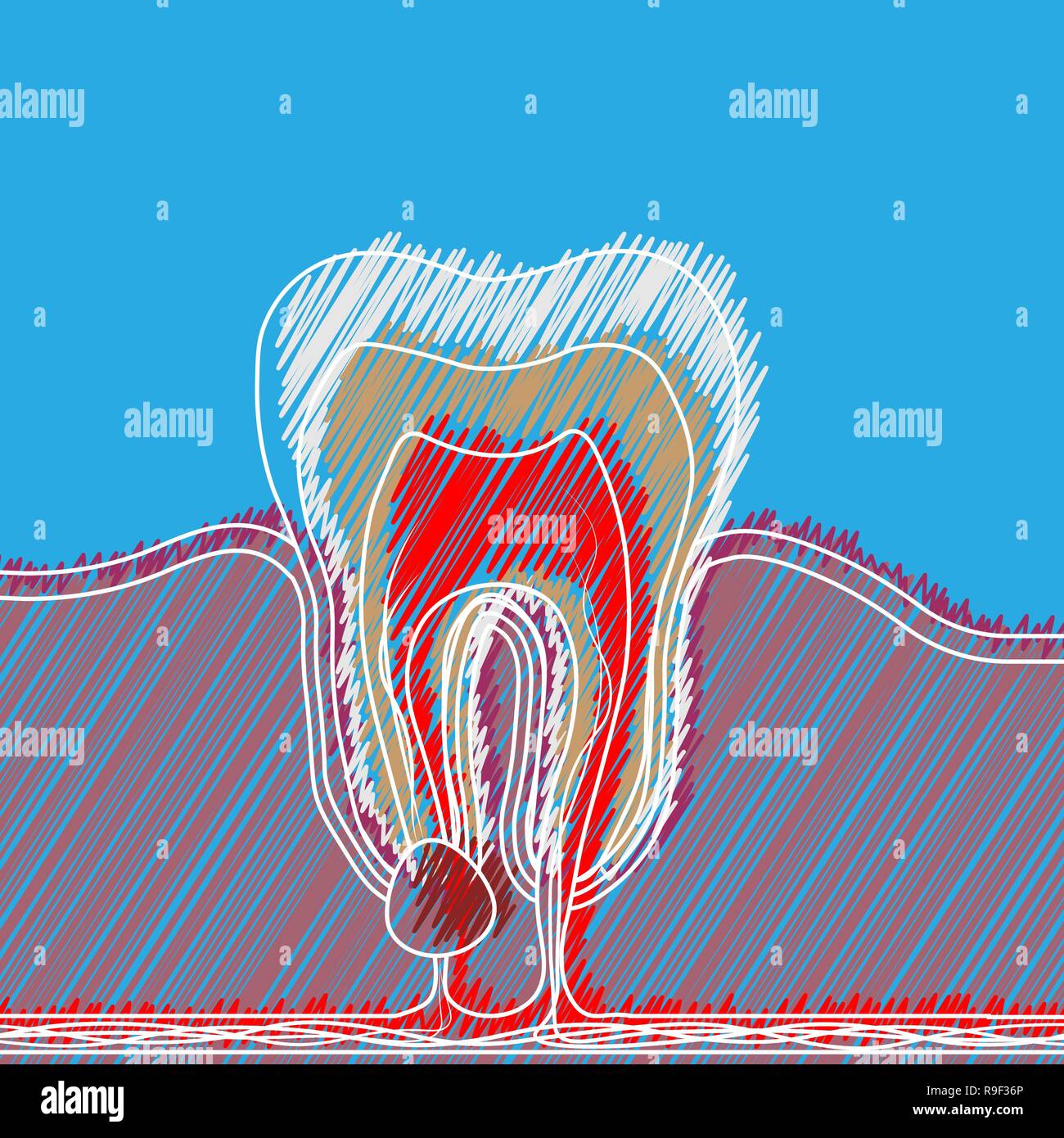L'éclosion des maladies dentaires stylisée avec un point de la douleur et l'inflammation. Illustration médicale de la racine de l'inflammation, de la racine dentaire pulpite kyste,. Illustration de Vecteur