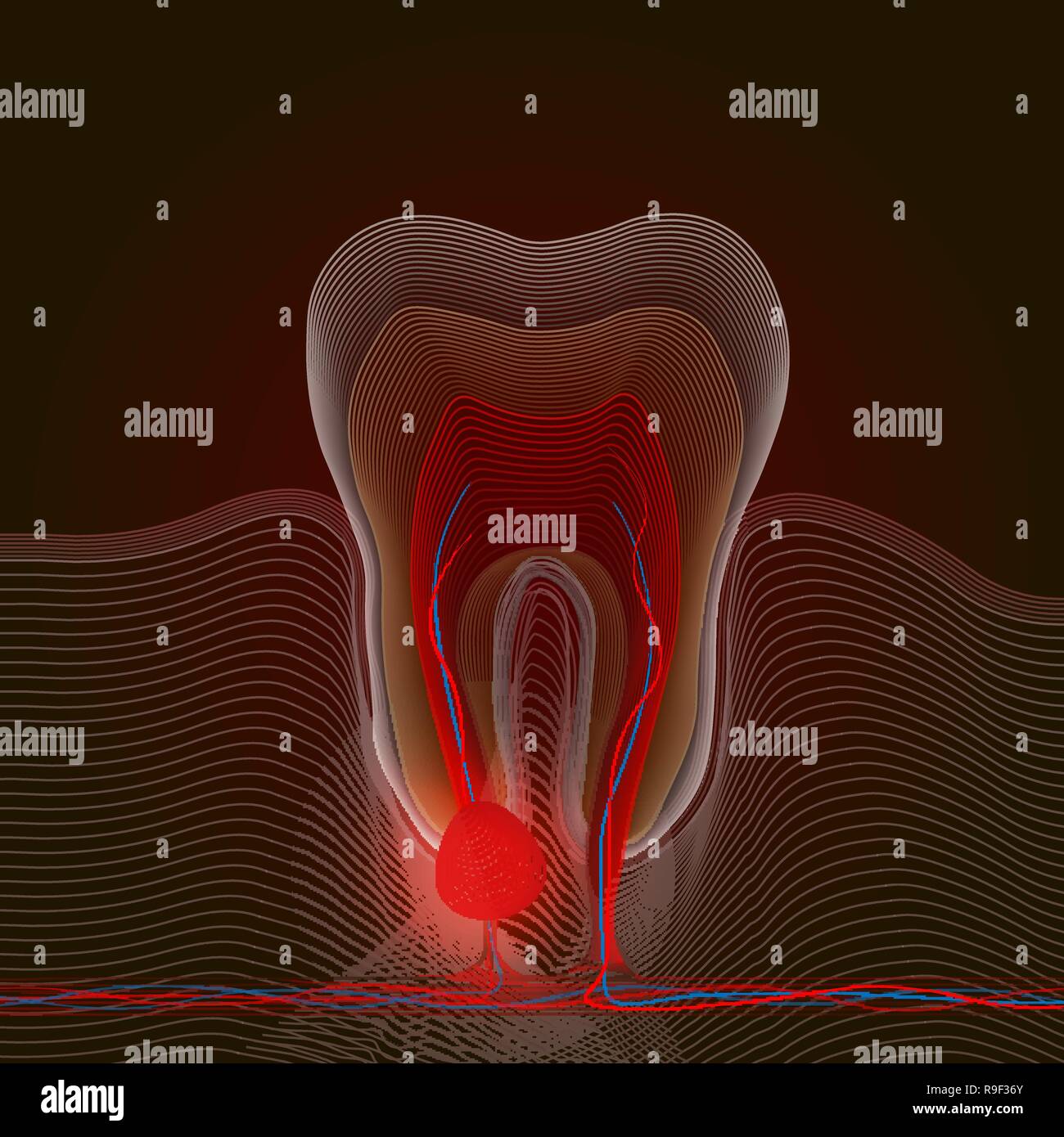 Stylisation linéaire de maladies dentaires avec un point de la douleur et l'inflammation. Illustration médicale de la racine de l'inflammation, de la racine dentaire pulpite, kyste Illustration de Vecteur