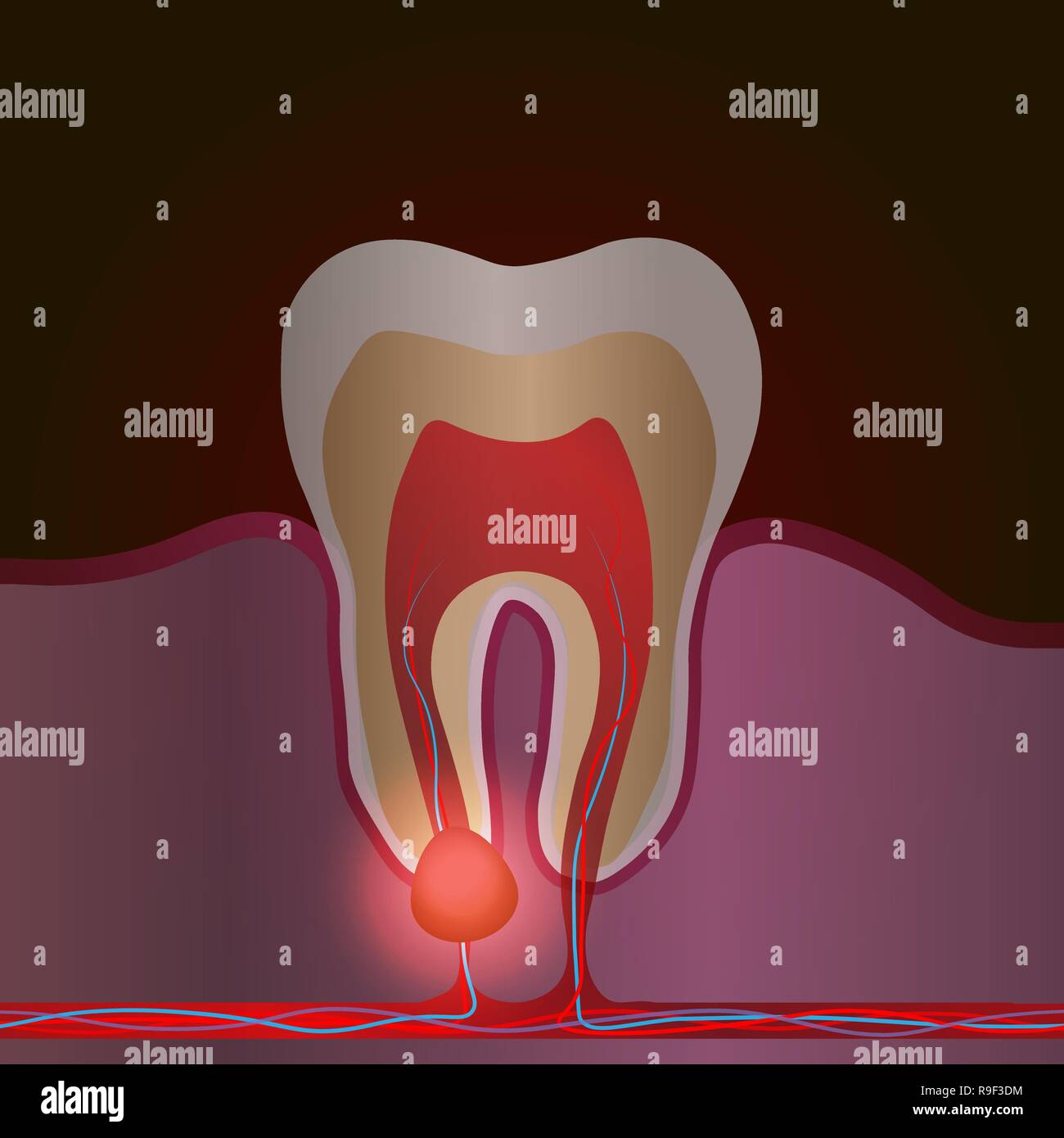 Les maladies dentaires avec la douleur et l'inflammation. Illustration médicale de la racine de l'inflammation, de la racine dentaire pulpite kyste,. Eps 10 Illustration de Vecteur